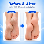 Wellzonez™ SmoothFeet Electric Callus Remover Kit